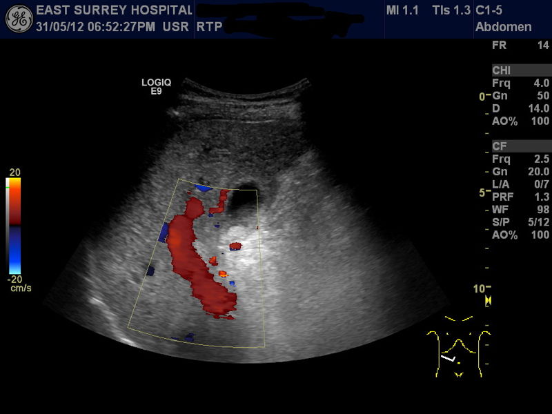 Ultrasound Scan - 31st May 2012