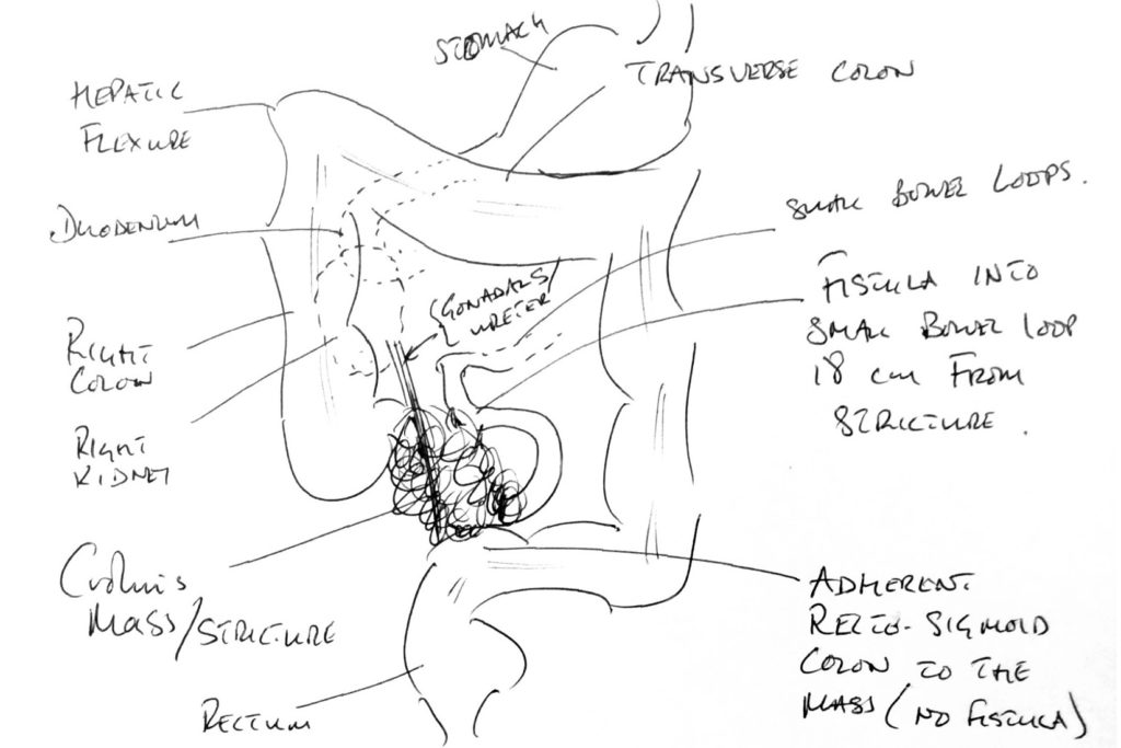 Operation drawing by surgeon